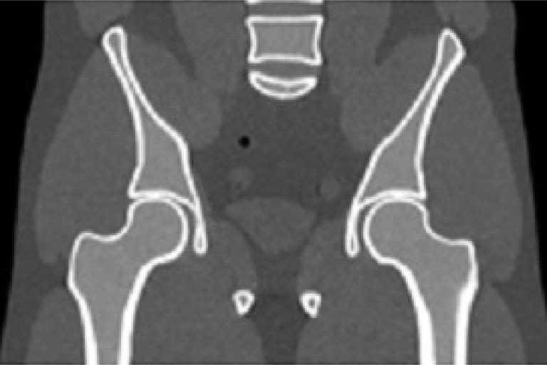 Fan-beam CT X-ray