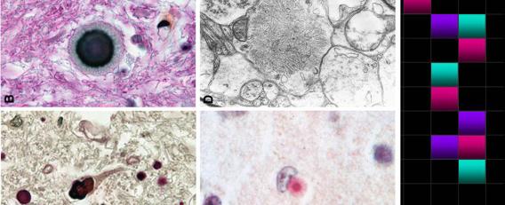 Culprits of Lafora Disease: Lafora bodies