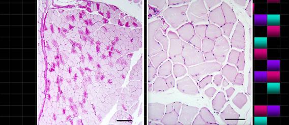 Reduction of Lafora bodies