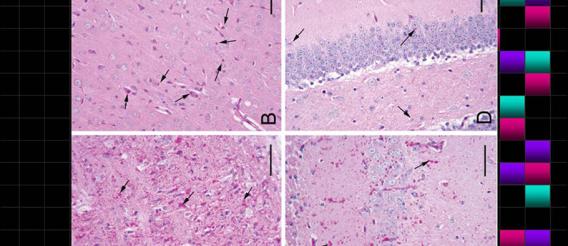 Reduction of Lafora bodies