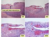ovarian surface epithelium