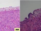 Initial Endometriosis