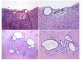 endosalpingiosis
